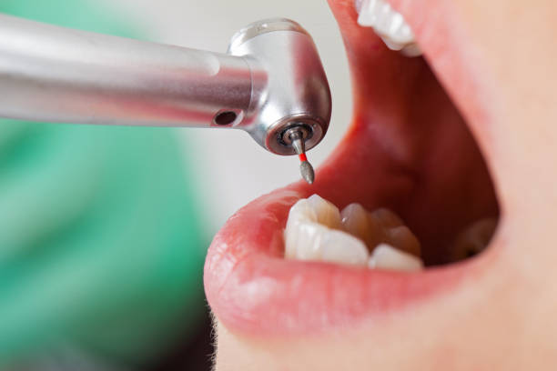 Best Emergency Tooth Extraction in Rio Pinar, FL